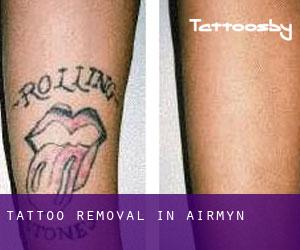 Tattoo Removal in Airmyn