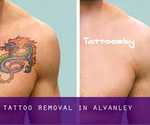 Tattoo Removal in Alvanley