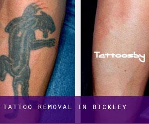 Tattoo Removal in Bickley