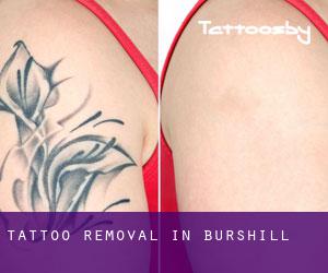 Tattoo Removal in Burshill