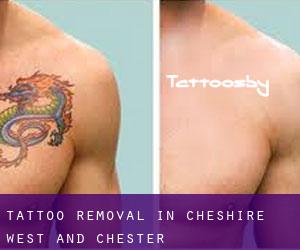 Tattoo Removal in Cheshire West and Chester