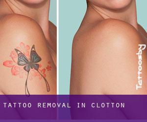 Tattoo Removal in Clotton