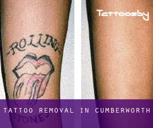 Tattoo Removal in Cumberworth