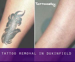 Tattoo Removal in Dukinfield