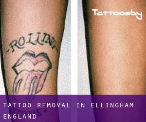 Tattoo Removal in Ellingham (England)