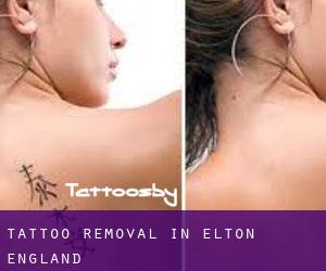 Tattoo Removal in Elton (England)