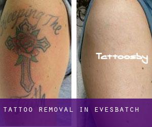 Tattoo Removal in Evesbatch