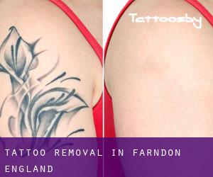 Tattoo Removal in Farndon (England)