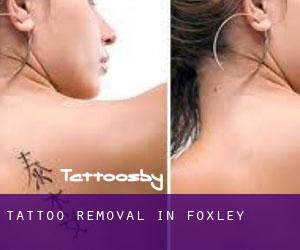 Tattoo Removal in Foxley