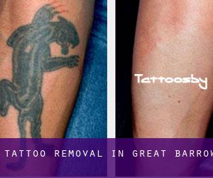 Tattoo Removal in Great Barrow