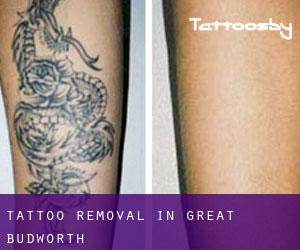 Tattoo Removal in Great Budworth