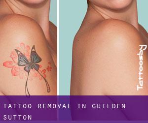 Tattoo Removal in Guilden Sutton