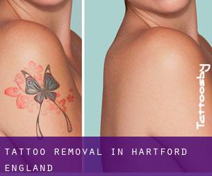 Tattoo Removal in Hartford (England)