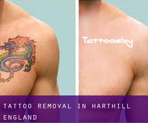 Tattoo Removal in Harthill (England)