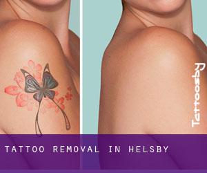 Tattoo Removal in Helsby