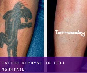 Tattoo Removal in Hill Mountain