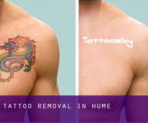 Tattoo Removal in Hume