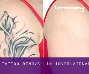 Tattoo Removal in Inverlaidnan