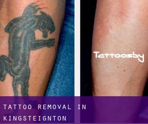 Tattoo Removal in Kingsteignton