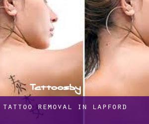 Tattoo Removal in Lapford