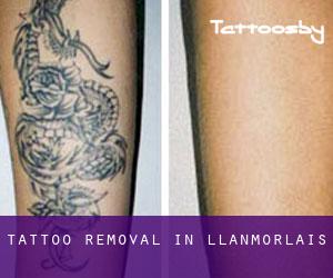 Tattoo Removal in Llanmorlais