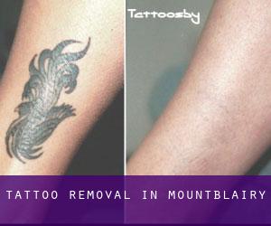 Tattoo Removal in Mountblairy